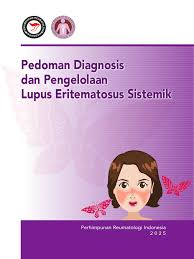 Pedoman diagnosis dan pengelolaan Lupus Eritematosus Sistemik