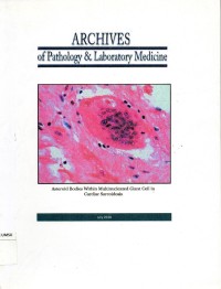 Archives of pathology & laboratory medicine : asteroid bodies within multinucleated giant cell in cardiac sarcoidosis
